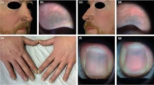 Blue Nail Discoloration: Literature Review and Diagnostic Algorithms