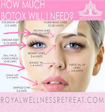 Wrinkles are caused by repeated movements and muscle contractions, which means they can even develop in younger adults. Botox Dysport Royal Aesthetics