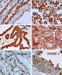 A definitive diagnosis of mesothelioma based on cytologic specimens is controversial. Evaluation Of 12 Antibodies For Distinguishing Epithelioid Mesothelioma From Adenocarcinoma Identification Of A Three Antibody Immunohistochemical Panel With Maximal Sensitivity And Specificity Modern Pathology