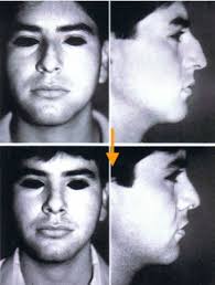 Double Eyelid Surgery in Tokyo, Japan, Eyelid Surgery, Liposuction, Breast  Augmentation, Breast lift (Mastopexy), Facelifts