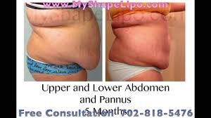 Image Result For Liposuction Results Liposuction Smart Lipo Lipo