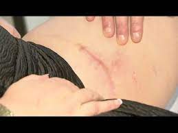 Avec 8 araign�es noires � longues pattes, � placer sur la toile pour cr�er l'ambiance d'halloween ! Les Morsures D Araignee Le Magazine De La Sante Youtube