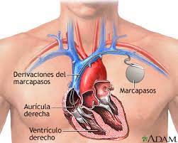 Marcapasos hernan genta feat marilina irureta gerardo lobriglio pato canevari. Marcapasos Cardiaco Medlineplus Enciclopedia Medica