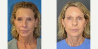 RealSelf: Andre Levesque, MD