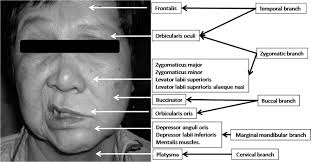 Webmedcentral Com A Systemic Approach To Facial Nerve