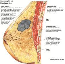 Folge 4 Brustkrebs Schockdiagnose Berlin Tagesspiegel