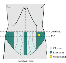 Palmer is a general surgeon in high point, nc. Vascular Injury During Laparoscopic Gynaecological Surgery A Methodological Approach For Prevention And Management Brierley 2020 The Obstetrician Amp Gynaecologist Wiley Online Library