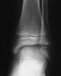 Fractures De La Cheville