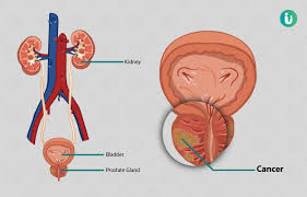 Learn more about the symptoms, treatments, and causes here. Prostate Cancer Symptoms Causes Treatment Medicine Prevention Diagnosis