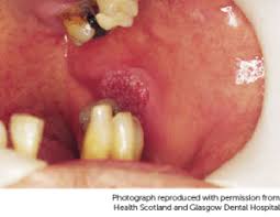 The signs and symptoms of throat cancer may be difficult to identify in the early stages of the disease. Mouth Head And Neck Cancer Marie Keating Foundation