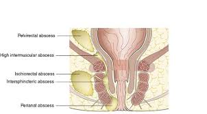 Image result for Ischiorectal Abscess