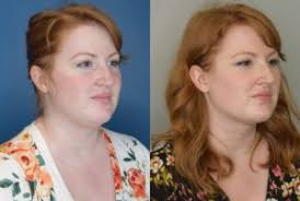 Removing this fat produces results as striking as a facelift. Jawline Contouring 3499 Chin Liposuction Double Chin Surgery