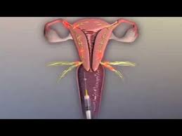 Image result for Paracervical Block