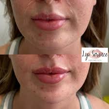 An lovely example of our 'contour package' 2.2ml used for chin, nasolabial  folds and a teeny bit for a lip top up … this package can also be combined  with antiwrinkle tox