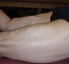 Hamstring injuries mostly occur while players are running or sprinting. Surgical Repair Of Proximal Hamstring Ruptures Reliably Improves Function