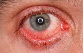 Based on the principal of compassionate service, our board certified vitreoretinal specialists are committed to each individual patient and the referral doctors in the community. Can Running Cause Retinal Detachment Or Make It Worse Runner S World