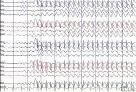 Image result for Absence Seizure