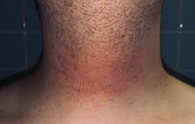 Roter Ausschlag Am Hals Durch Haut Ol Beauty Pflege Kosmetik