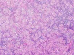 It level plodovnica po kapljicah sunday funday ex 2012 tarik phillips wvu scottish wool, per fisher. Hematopathology Case Study A 36 Year Old Woman With An Incidental Neck Mass Lablogatory