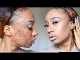 12 Color Correcting Tutorials That Will Change The Way You Apply Concealer Acne Foundation Cover Hyperpigmentation Color Correcting Concealer