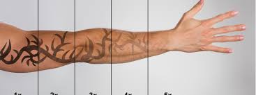 Rest easy — while laser tattoo removal can hurt, chances are it won't hurt as much as getting the tattoo did. How Does Laser Tattoo Removal Work Steemit