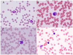 Image result for Peripheral Smear