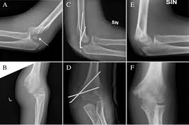 Transphyseal fractures of the distal humerus are most commonly seen in children younger than six years of age. Recent Trends In Children S Elbow Dislocation With Or Without A Concomitant Fracture Bmc Musculoskeletal Disorders Full Text