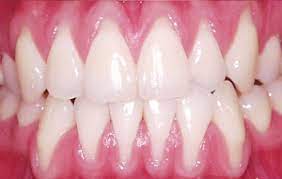 Gum Disease Barrie On Dr Steve Mocrae