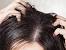 Hair Fungal Infection Treatment