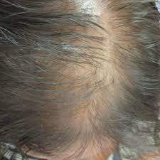 Androgenic Alopecia An Entity To Consider In Adolescence Bmj Case Reports