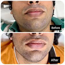 Image result for Beard Dermatitis