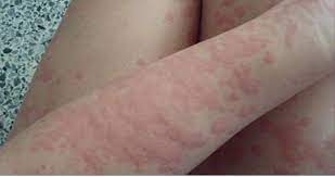 7 Types Of Rashes You Should Never Ignore These Are The Warning Signs What Do Bed Bugs Tick Bites An Types Of Rashes Skin Rashes Pictures Bed Bugs Bites Skin