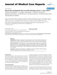 Small cell lung cancer (sclc), also known as oat cell lung cancer, is small cell carcinoma of the lung is the most common cause of svc obstruction, due to both compression/thrombosis advanced disease (stage iv) is managed only with chemotherapy, primarily for palliation and symptom control. Pdf Facial Skin Metastasis Due To Small Cell Lung Cancer A Case Report