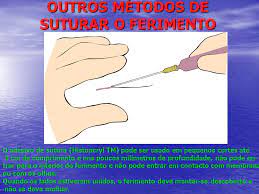 Tratamentos Das Feridas Da Anestesia A Sutura Ppt Video Online Carregar