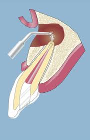 You may receive a temporary crown or a filling after the root canal while a more permanent restoration is made. Root Canal Treatment Praxis Am Kureck