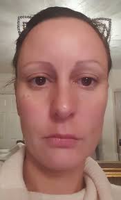 Retin A. Eternal youth?