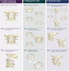 Image result for Subaxial Injury Classification Scale