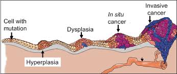 The process of closer examination using a microscope is called histology. Evolution Of A Cancer