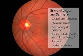Sehnerv Erkrankungen Ursachen Symptome Behandlung