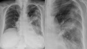 Elle peut entraîner des complications pulmonaires et sans traitement peut mener au décès. Legionella Pneumonitis Pacs Entwicklung