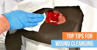 The first action in this care is cleaning,. Top Tips For Best Wound Cleansing Practices Wcei