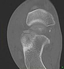 Image result for Calcaneus Compression Fracture
