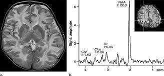 Canavan Disease In A 6 Month Old Infant Who Presented With Hypotonia Download Scientific Diagram