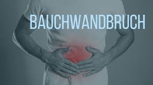 So ganz auf die schnelle wird das auch nicht gehen. Bauchwand Und Leistenbruche Dreo