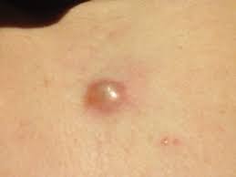 Gros Bouton Rouge Tres Douloureux Resolu Dermatologie Journal Des Femmes