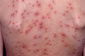 Neonatal herpes simplex virus infections can result in serious morbidity and mortality. Paediatric Medicine Viral Skin Infections In Children Gponline