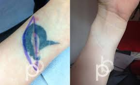 I read that large tattoos will need a skin graft but a surgical excision is certainly an option for smaller tattoos in certain areas of the body but a larger tattoo on. Tattoo Removal London Stunning Results Paul Banwell