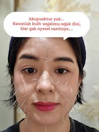 acupuncture #akupunktur # #akupunkturfacelift #akupunkturslimming #ak...