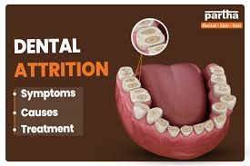 Image result for Tooth Attrition