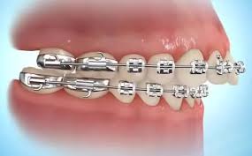 Elastics/rubber bands are an extremely effective tool that dr. How To Put Rubber Bands On Braces Premier Orthodontics